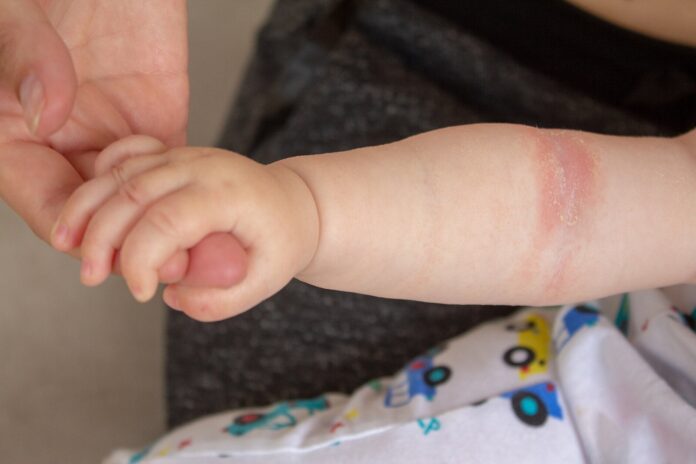 bebe-dermatitis-eczema
