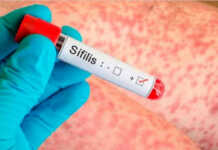 Alarmante aumento de sífilis en Argentina: Córdoba encabeza el ranking de crecimiento