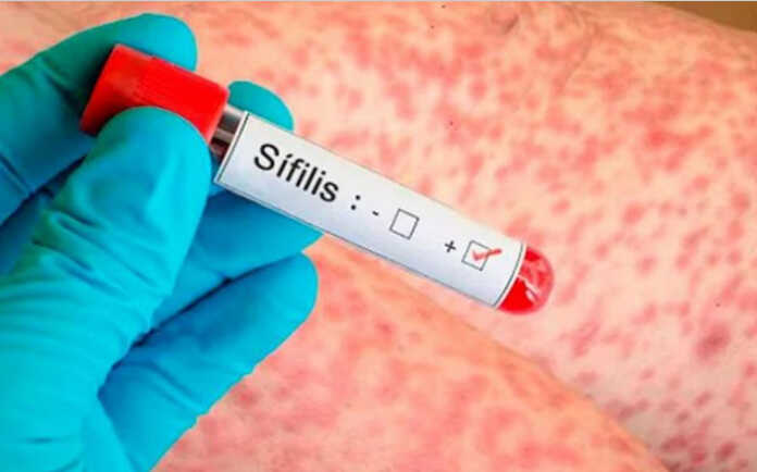casos de sífilis