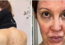 Miriam Lanzoni conmovió a sus seguidores al mostrar su lucha contra la psoriasis: “Sentí mucha vergüenza”