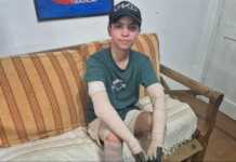 Le explotó el celular, sufrió graves quemaduras y permaneció 2 meses internado