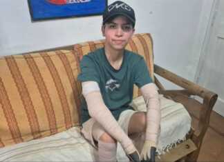 Le explotó el celular, sufrió graves quemaduras y permaneció 2 meses internado