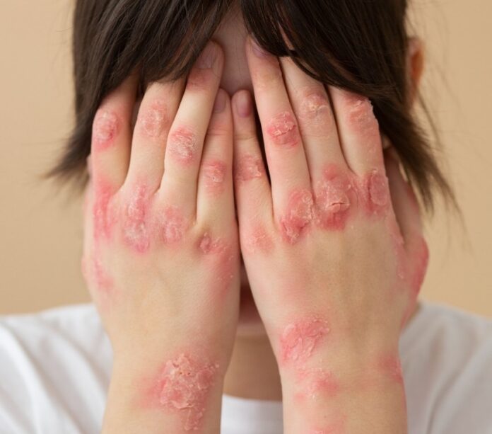 psoriasis