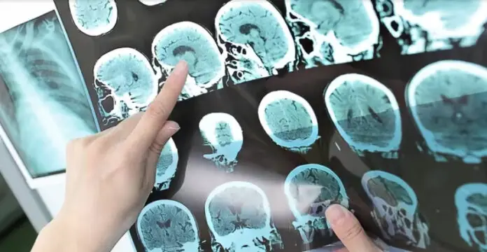 Alzheimer