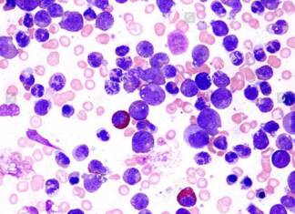 Tratamiento de la leucemia: especialistas analizan un cambio de paradigma para vencer la enfermedad