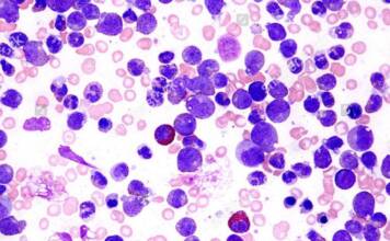 Tratamiento de la leucemia: especialistas analizan un cambio de paradigma para vencer la enfermedad